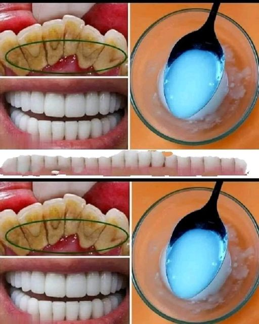 Getting rid of dental plaque: 6 natural methods