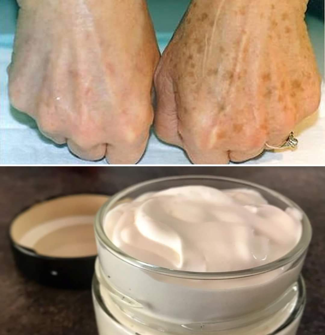 How to Remove Skin Blemishes and Wrinkles from Hands in No Time