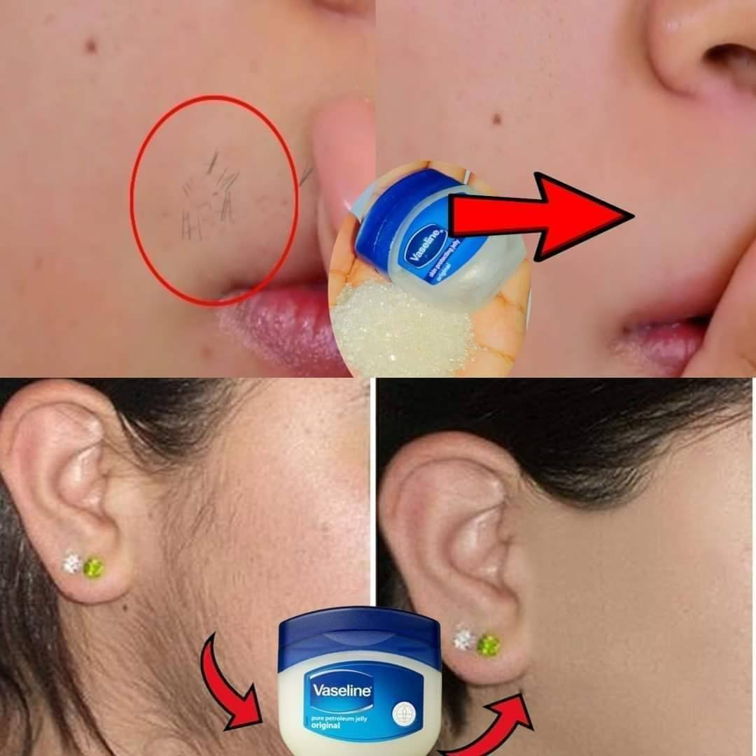 Vaseline for Upper Lip Hair Removal | Vaseline to Remove Facial Hair Permanently