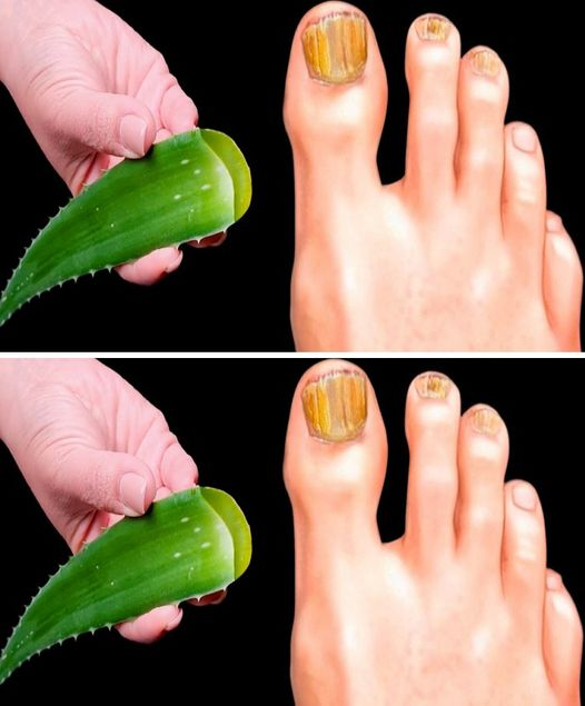 Immediately eliminates nail fungus! The best remedy!