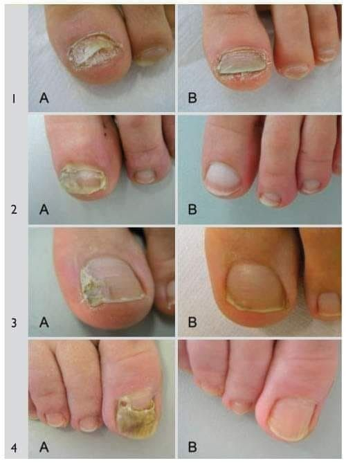 5 natural remedies to treat nail fungus